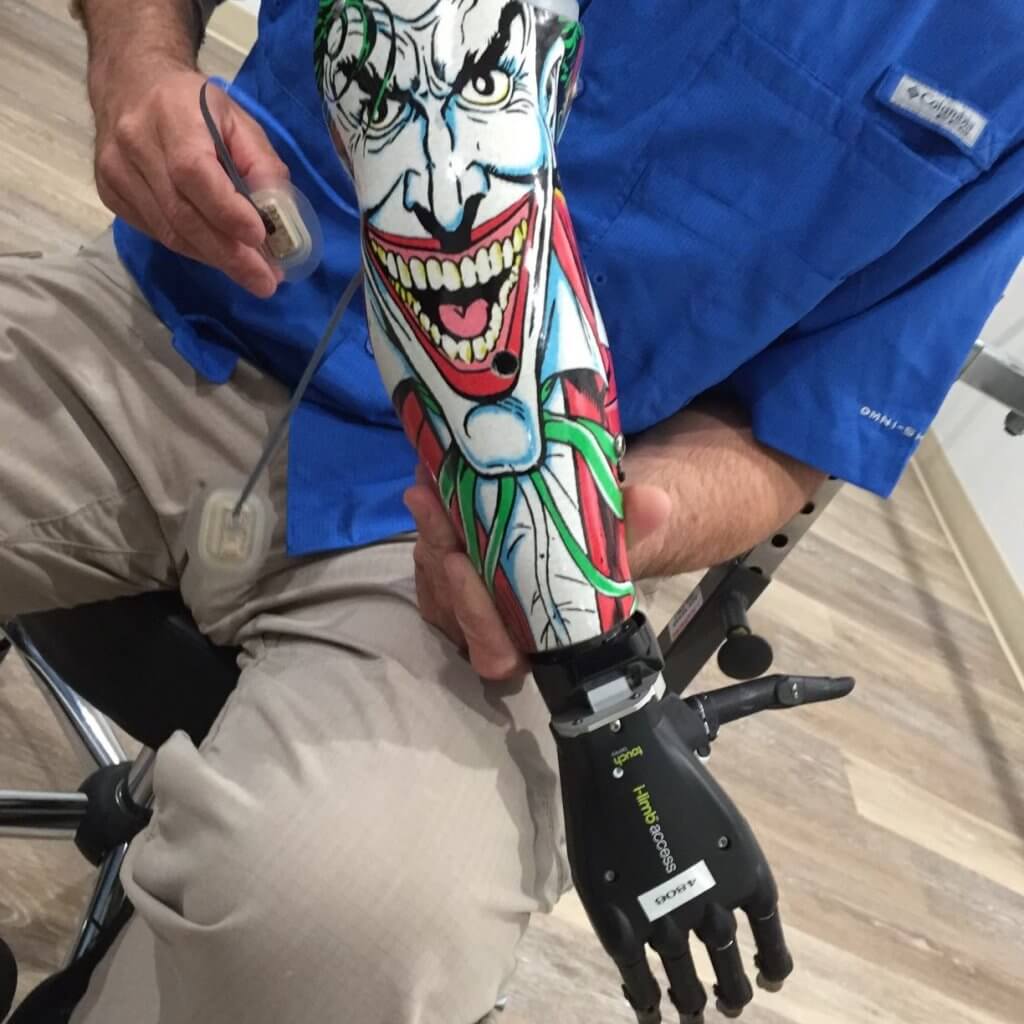 Custom upper-limb prosthesis with a patterned socket and prosthetic hand